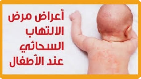 تشنجات وتلف الدماغ .. الصحة تكشف أعراض الإصابة بالتهاب السحايا الفيروسى 