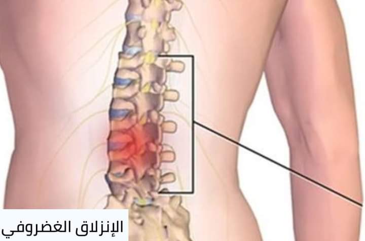 تعرفوا أكتر عن مرض الانزلاق الغضروفي    ما هو مرضي الانزلاق الغضروفي؟  