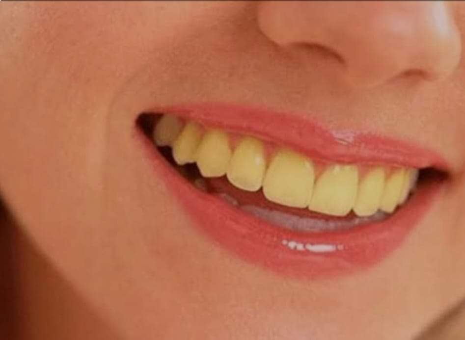 هذة العادات الخاطئة تسبب اصفرار الاسنان 