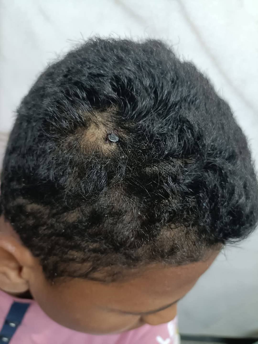 استخراج مسمار اخترق رأس طفل يبلغ 11 عامًا بمحافظة الفيوم