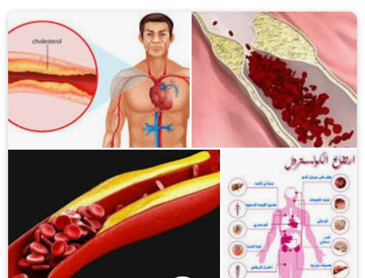 الأسباب الخقيقية وراء الاصابة بالكوليسترول وكيفية تفادية