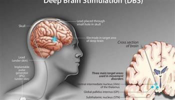دراسة أمريكية: تقنية التحفيز العميق للدماغ قد تساعد في علاج السكتات الدماغية