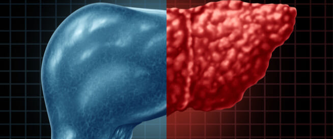 هل وجود الدهون على الكبد خطيرة؟ وما هي التحاليل التي تكشفها؟